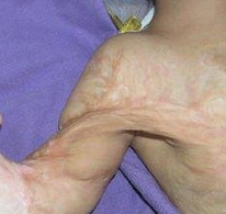 42岁的张女士烧伤疤痕病例介绍｛青岛疤痕医院｝