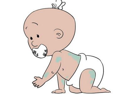 青岛皮肤病医院-新生婴儿的胎记容易治疗