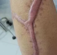 青岛皮肤病医院：皮肤张力与增生性疤痕“蜈蚣疤痕”关系及形成原因？