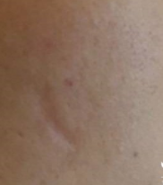青岛皮肤病医院去除这种小凹疤痕需要多少钱呢？