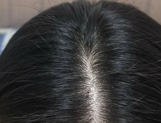 青岛皮肤病医院分享：女性脱发的7个原因，学习如何对症下药！