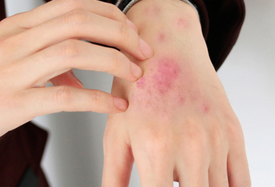 什么因素会导致湿疹呢？青岛皮肤科医生做了如下4个介绍